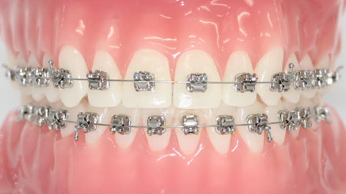 Types of Braces  Little Champions Pediatric Dentistry