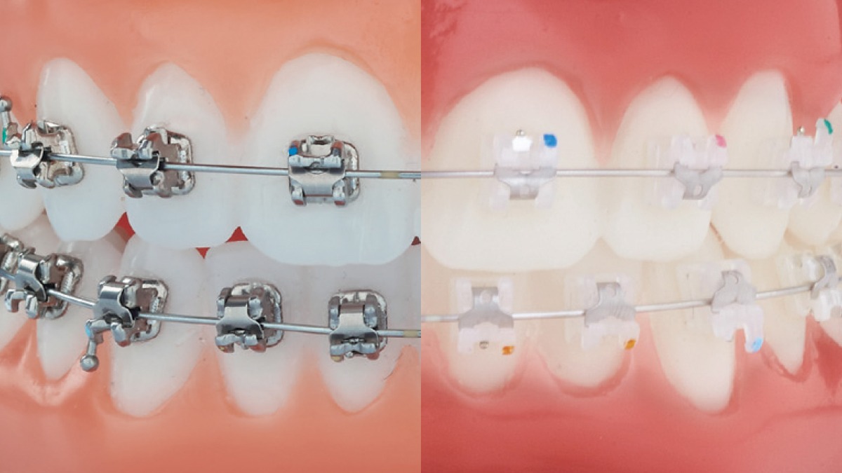 Clear Braces vs. Traditional Braces - Fort Lee Family Dental Fort