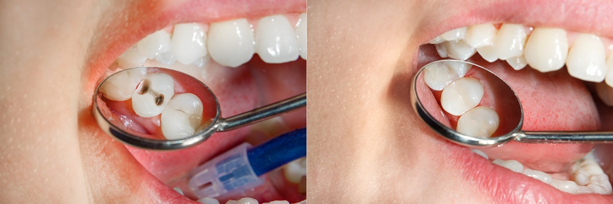 What is the Difference Between White Fillings and Silver Fillings - Resin